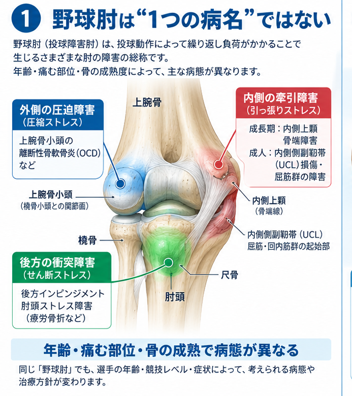 野球肘の症状・解剖・特徴を示す医学イラスト