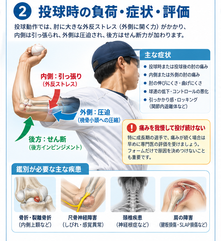 野球肘の原因・評価・鑑別を示す医学イラスト