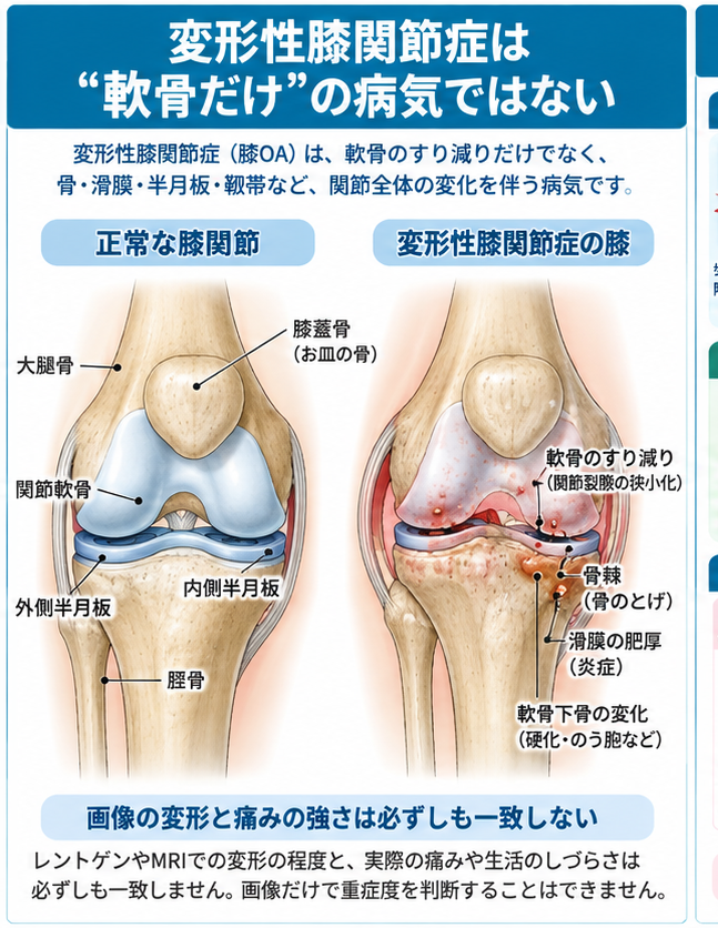 変形性膝関節症の症状・解剖・特徴を示す医学イラスト