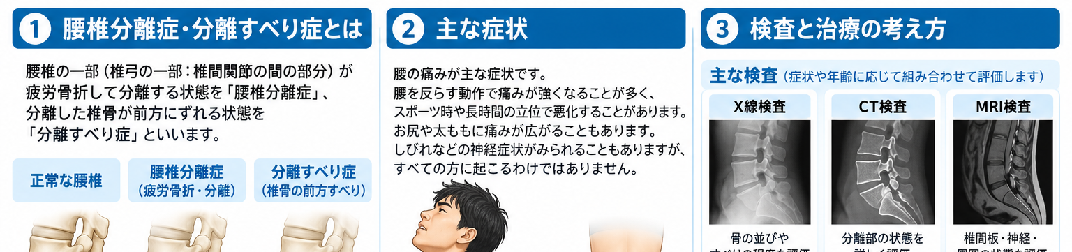腰椎分離症・分離すべり症の症状・解剖・特徴を示す医学イラスト