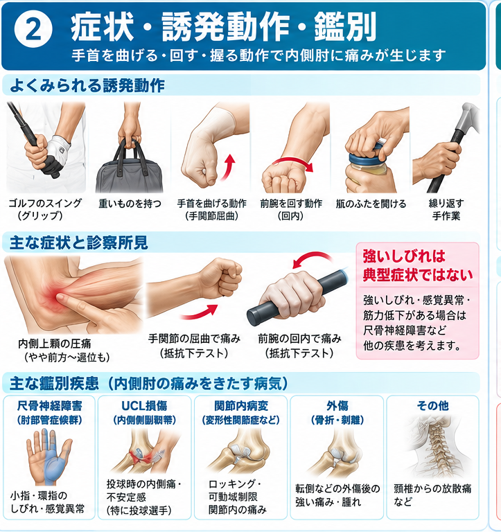 ゴルフ肘の原因・評価・鑑別を示す医学イラスト