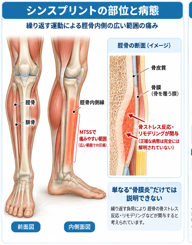 シンスプリントの症状・解剖・特徴を示す医学イラスト
