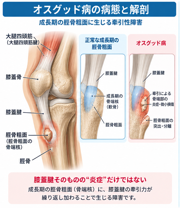 オスグッド病の症状・解剖・特徴を示す医学イラスト