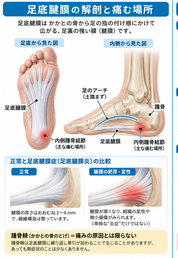足底腱膜炎の症状・解剖・特徴を示す医学イラスト