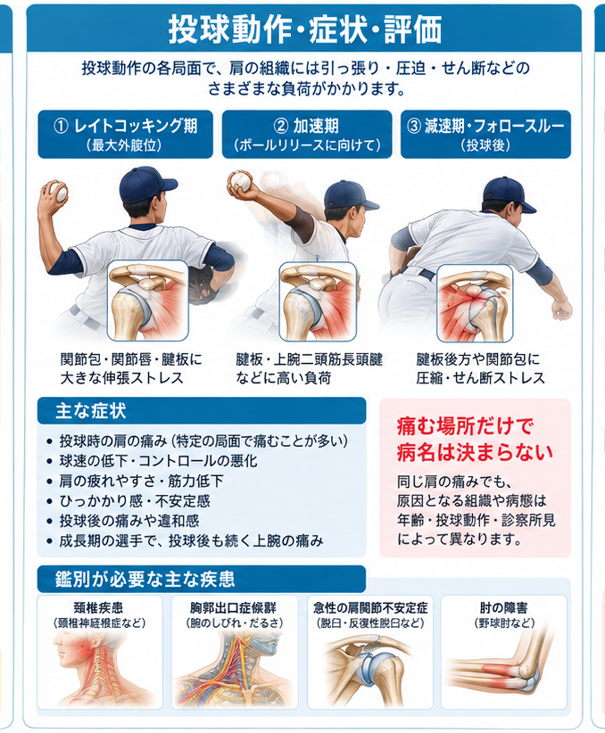 野球肩の原因・評価・鑑別を示す医学イラスト
